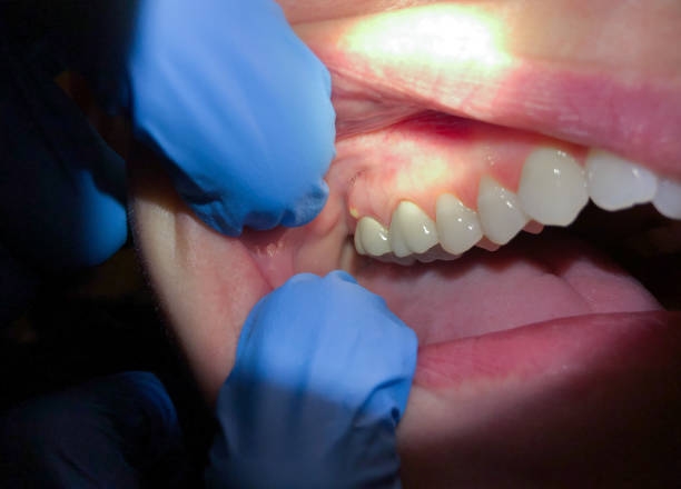 Best Chipped Tooth Repair Near Me  in Rimersburg, PA